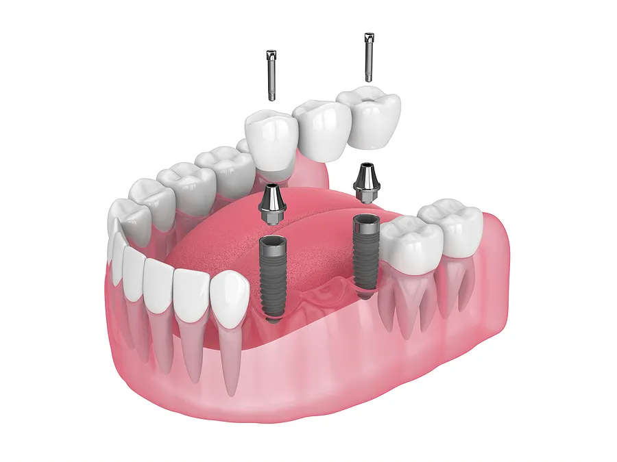 The Different Types of Dental Bridges