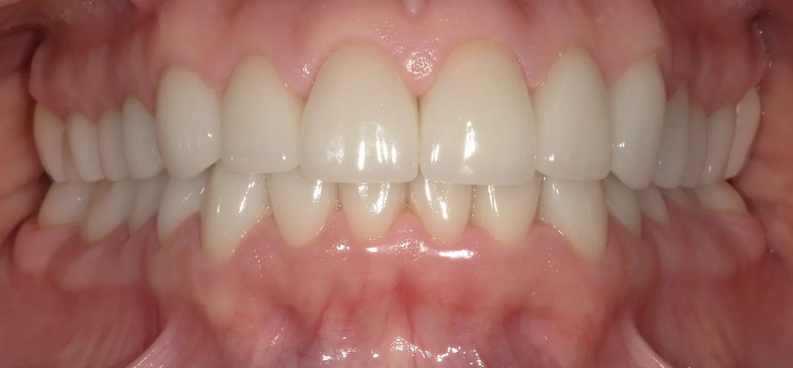 After Treatment After Treatment