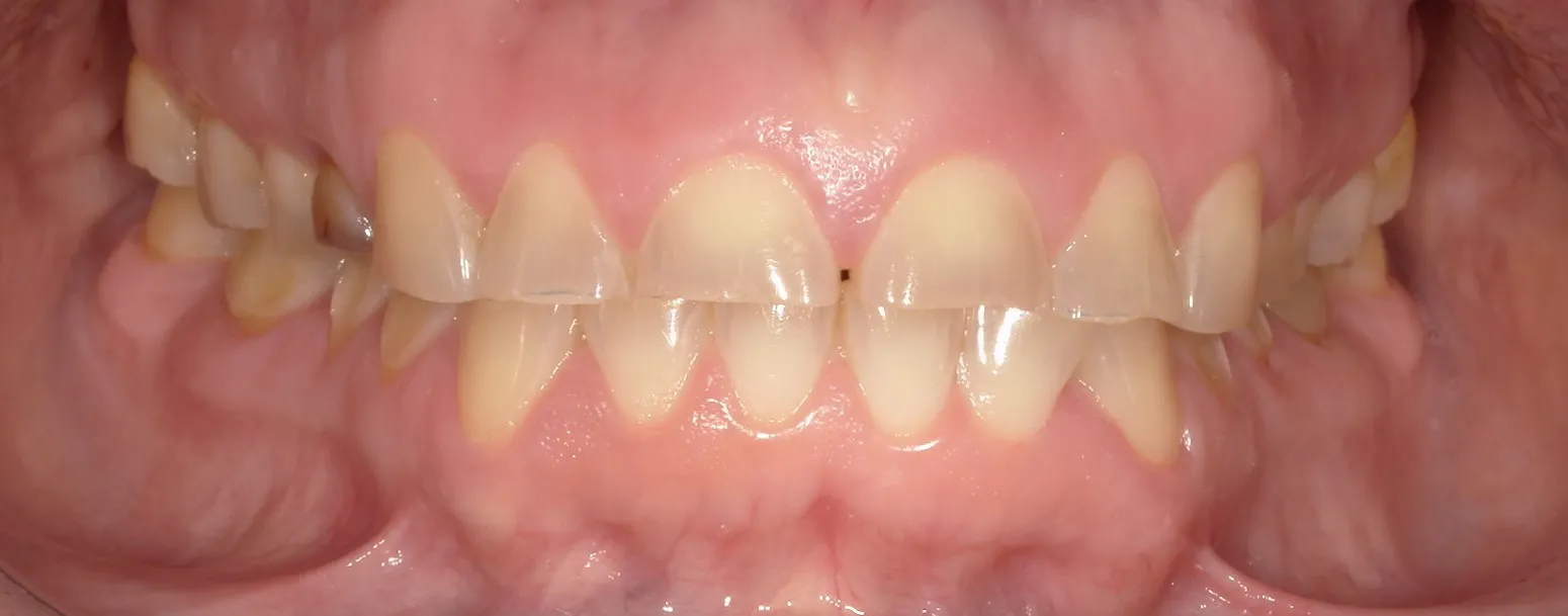 Before Treatment Before Treatment