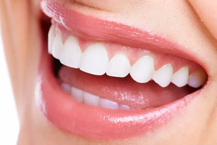 What Are Dental Veneers? A Complete Guide to Transforming Your Smile