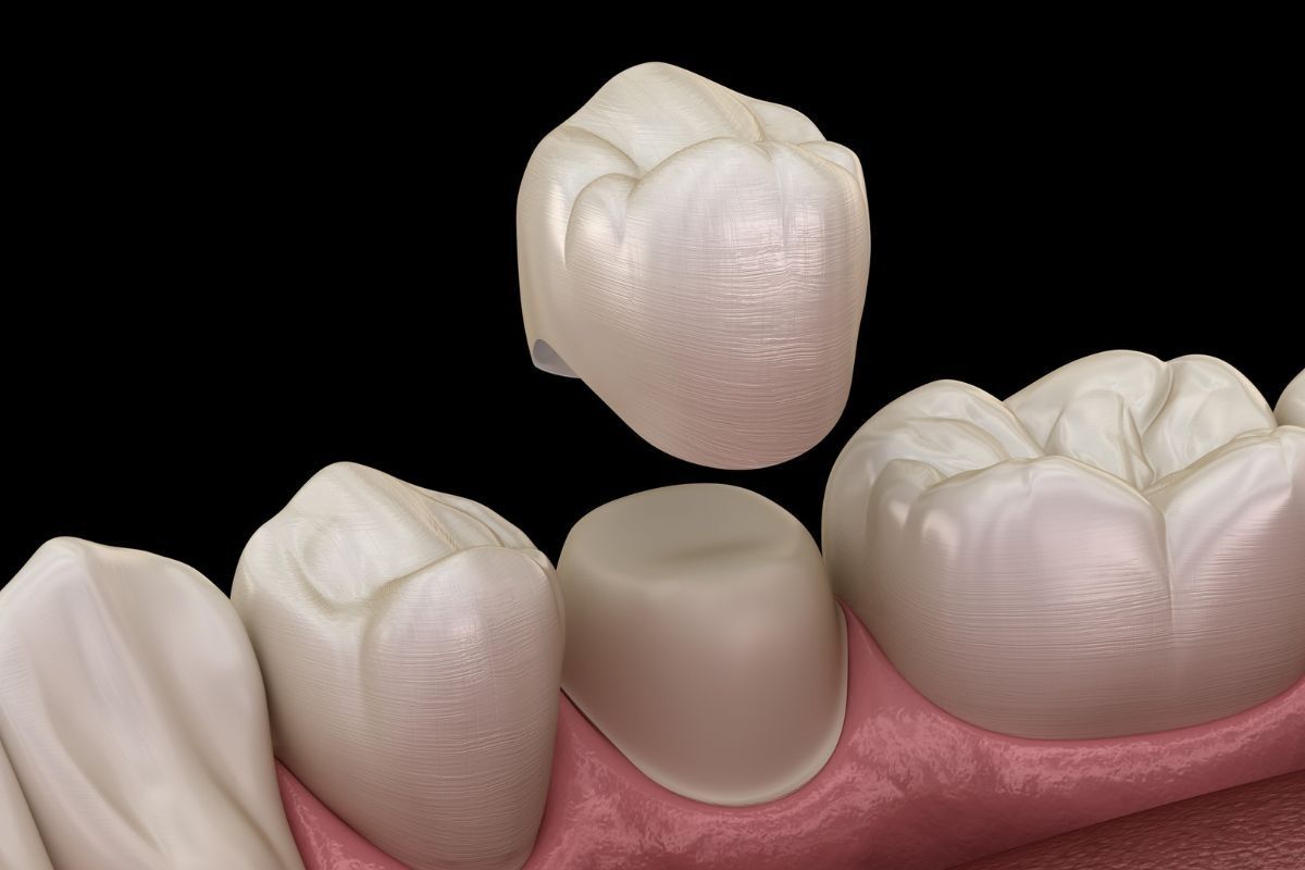 Are Dental Crowns Painful? What to Expect During Treatment