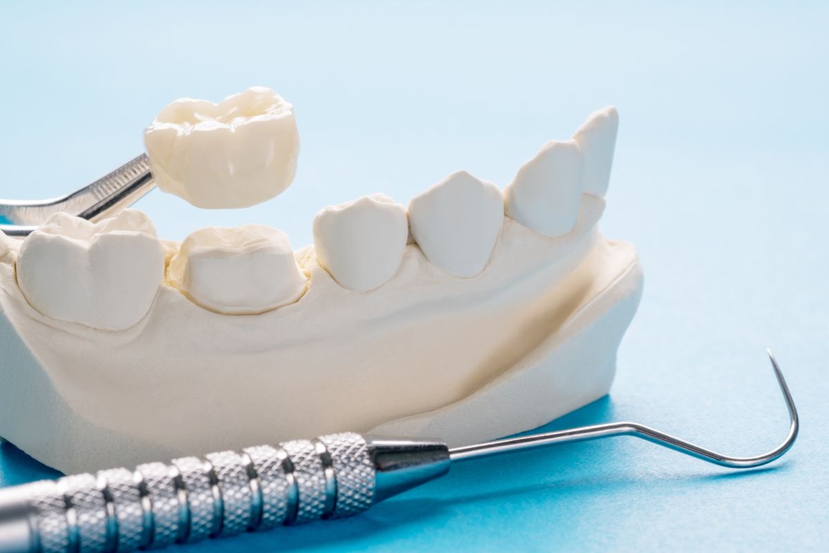 Can a Dental Crown Save a Cracked or Damaged Tooth?