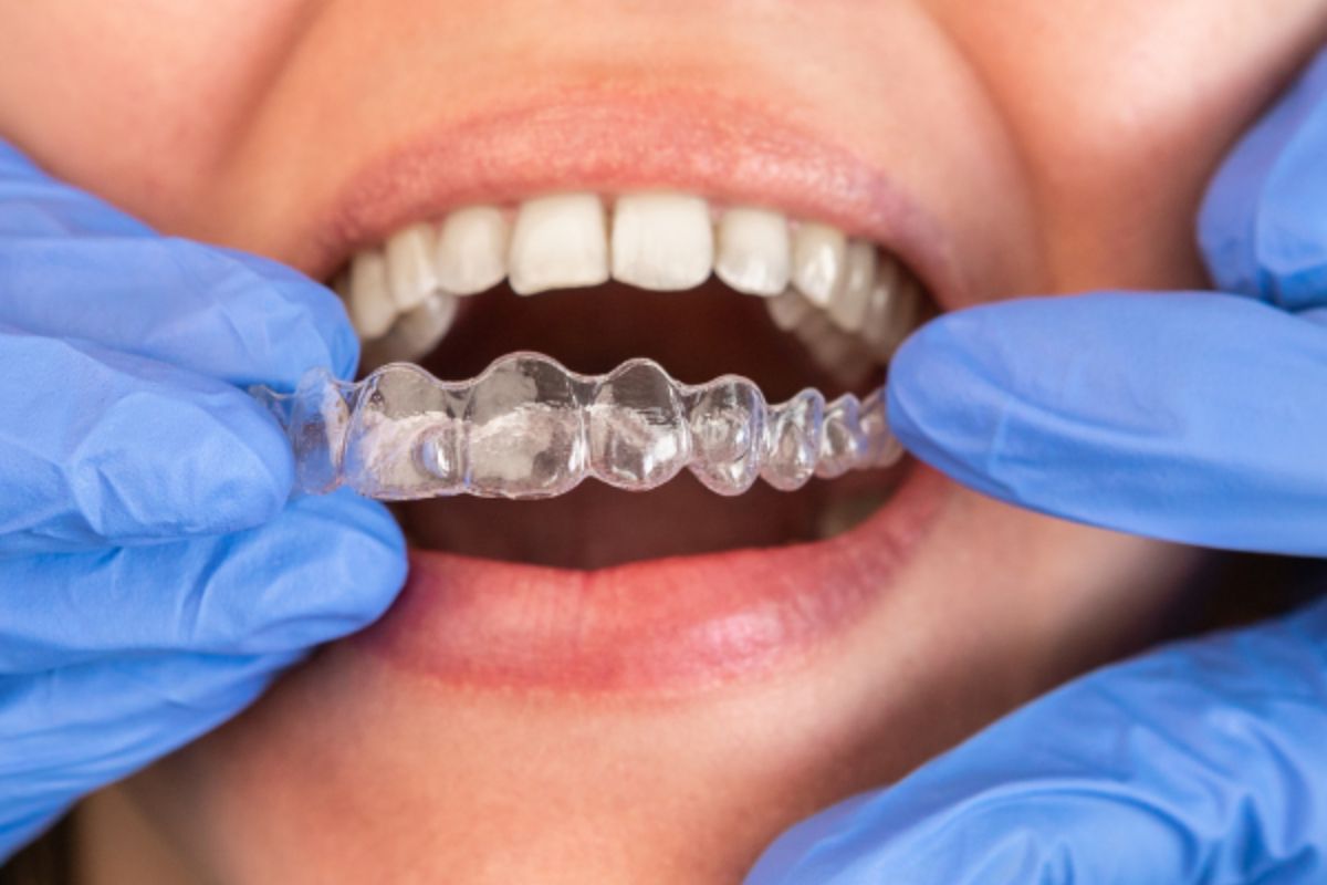 Invisalign Before and After: What Changes Can You Expect During Treatment?